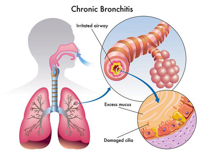 demystifying bronchitis - causes, symptoms and treatment