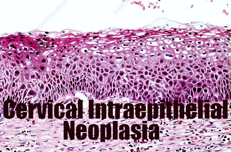 cervical intraepithelial neoplasia - symptoms, causes and treatment