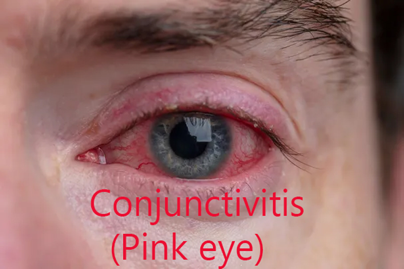 conjunctivits - pink eye causes and treatment