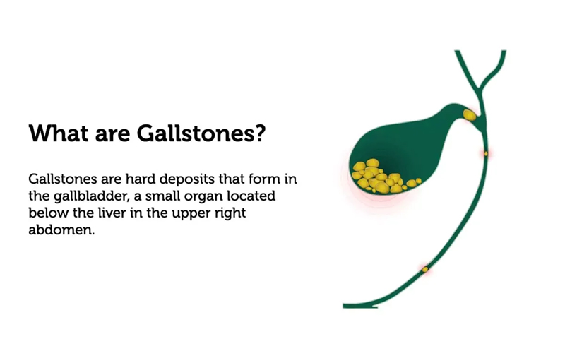gallstones - causes, symptoms, diagnosis and treatment