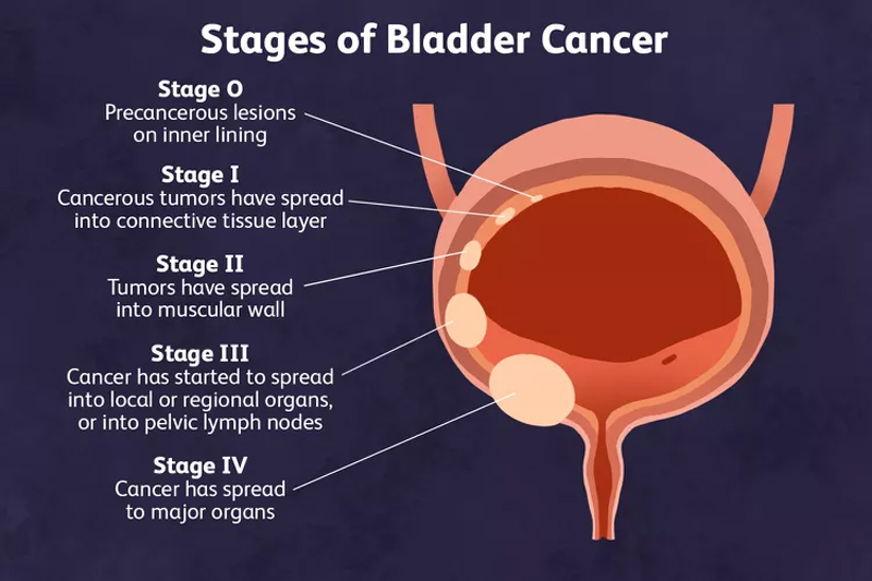 Bladder Cancer - Symptoms, Strategies and Hopeful Paths
